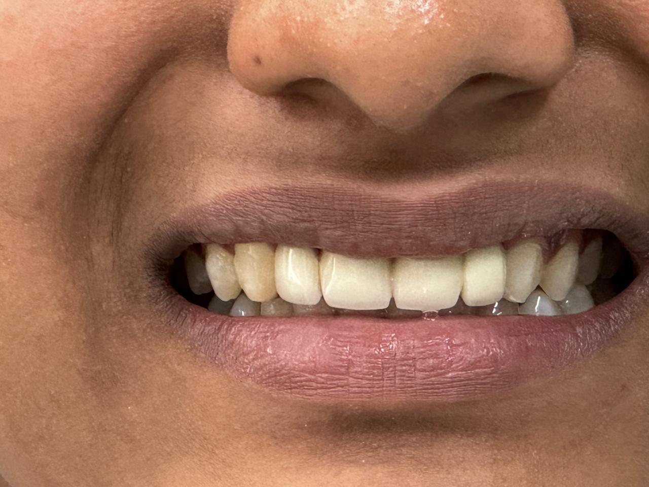 Replacement of congenitally missing front teeth after treatment